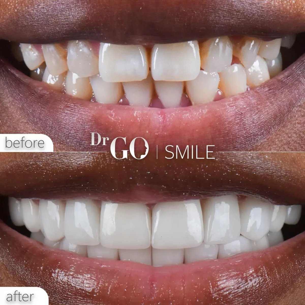 Before and after braces results at DrGO Smile Clinic – straighter teeth and improved smile