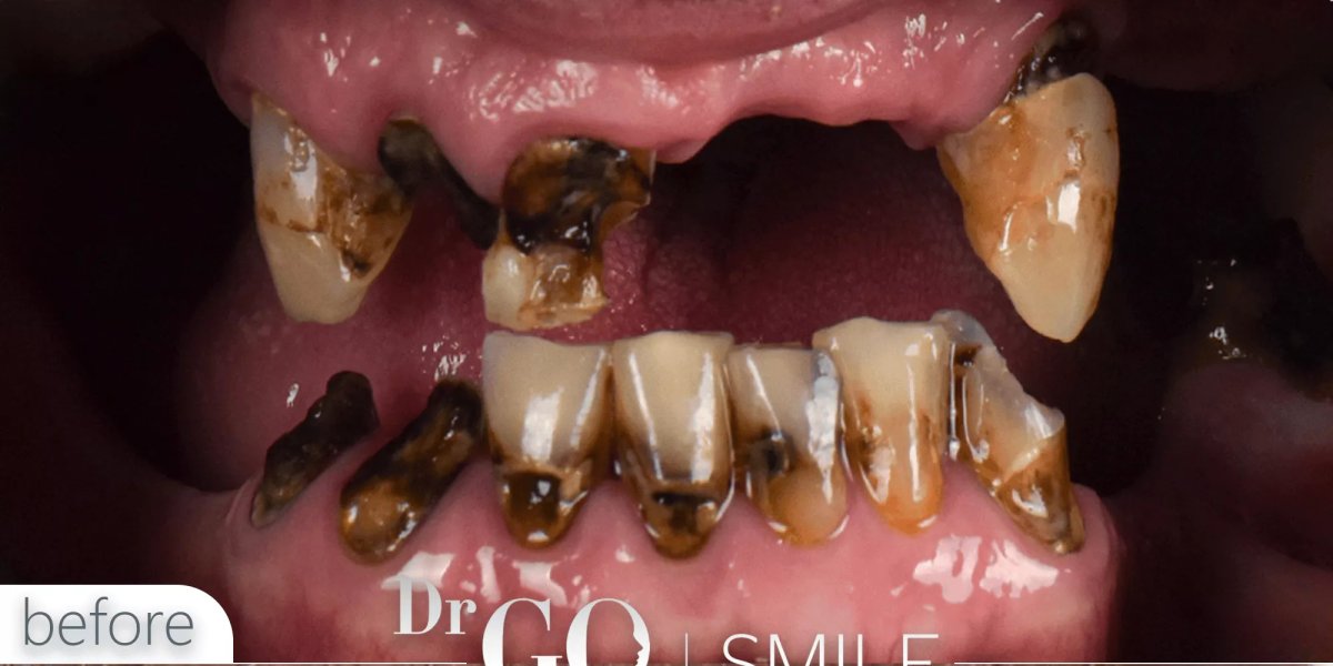 أسنان متحللة بشدة قبل زراعة الأسنان مع التاج في DrGO Smile Clinic، الحالة الأولية