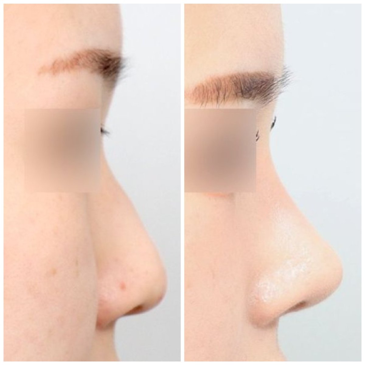 Resultados de rinoplastia secundaria antes y después en AB Plastic Surgery – perfil nasal mejorado