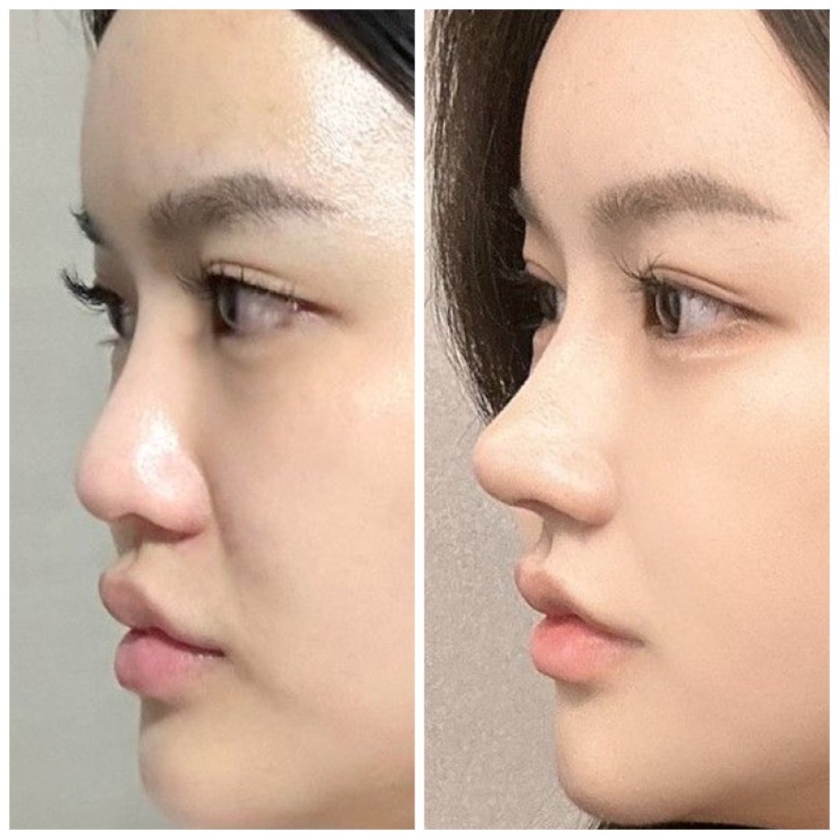 Before and after revision rhinoplasty result at AB Plastic Surgery, improved nose profile