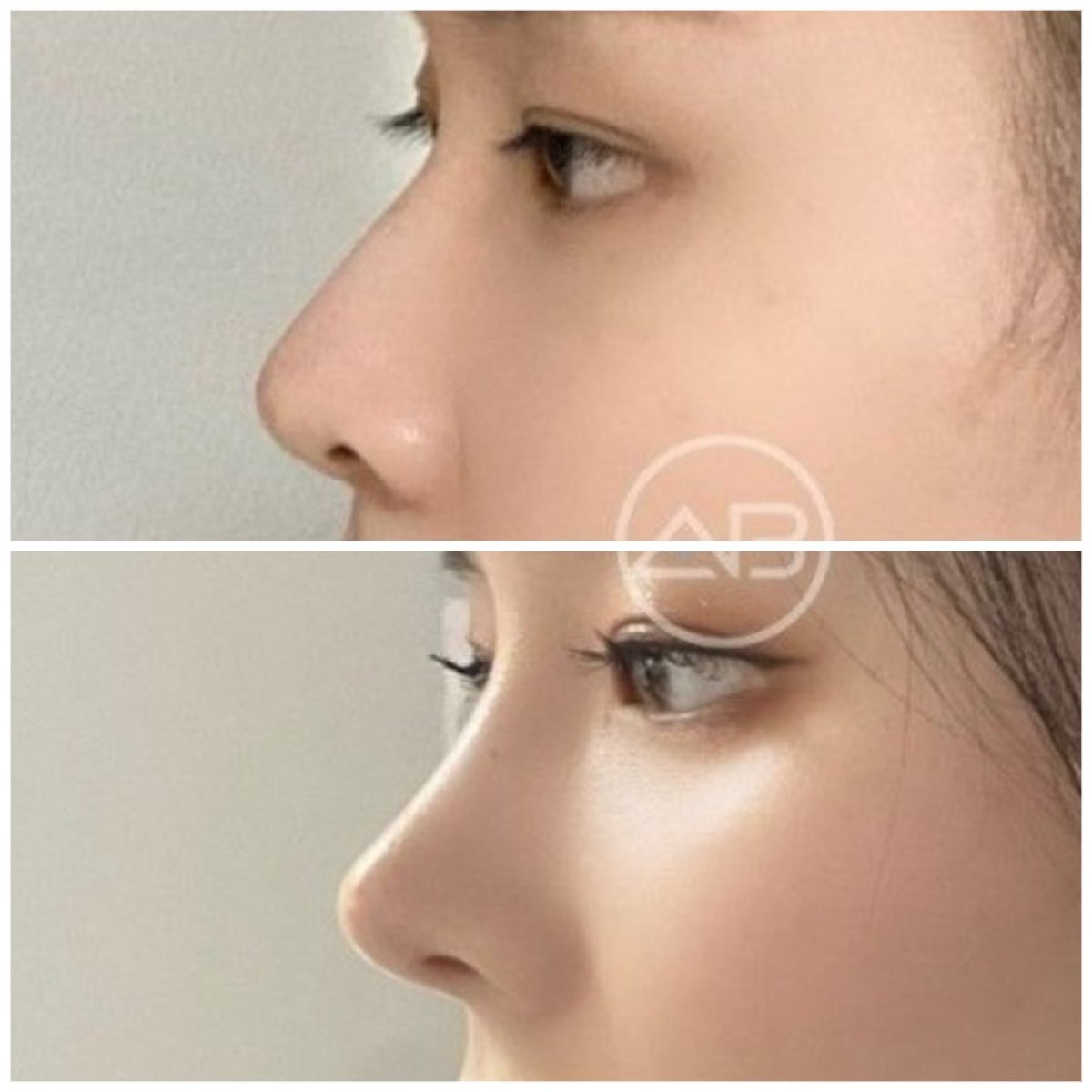 Resultado antes y después de rinoplastia secundaria en AB Plastic Surgery, perfil nasal mejorado