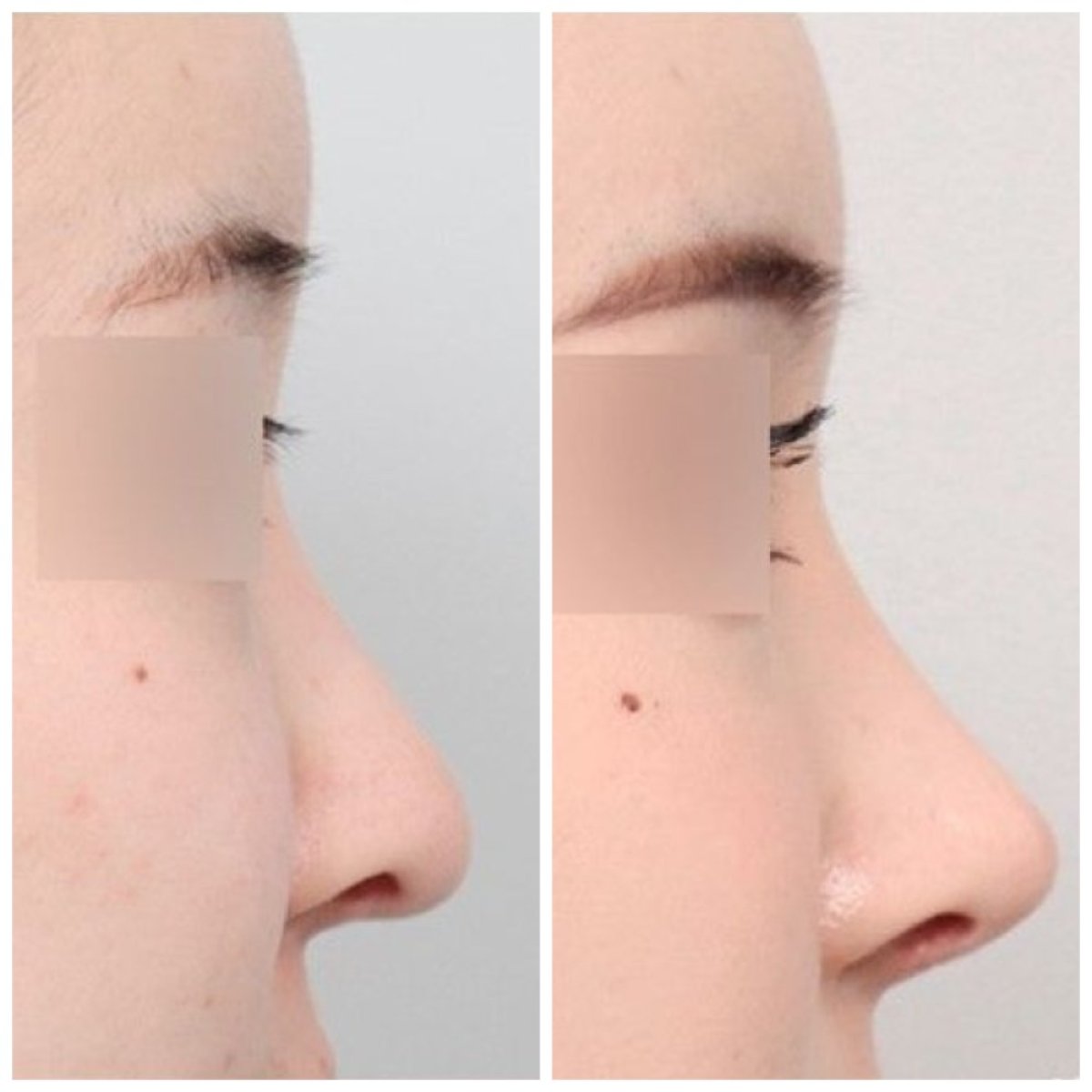 نتائج قبل وبعد عملية تجميل الأنف التصحيحية في AB Plastic Surgery، تحسين شكل الأنف