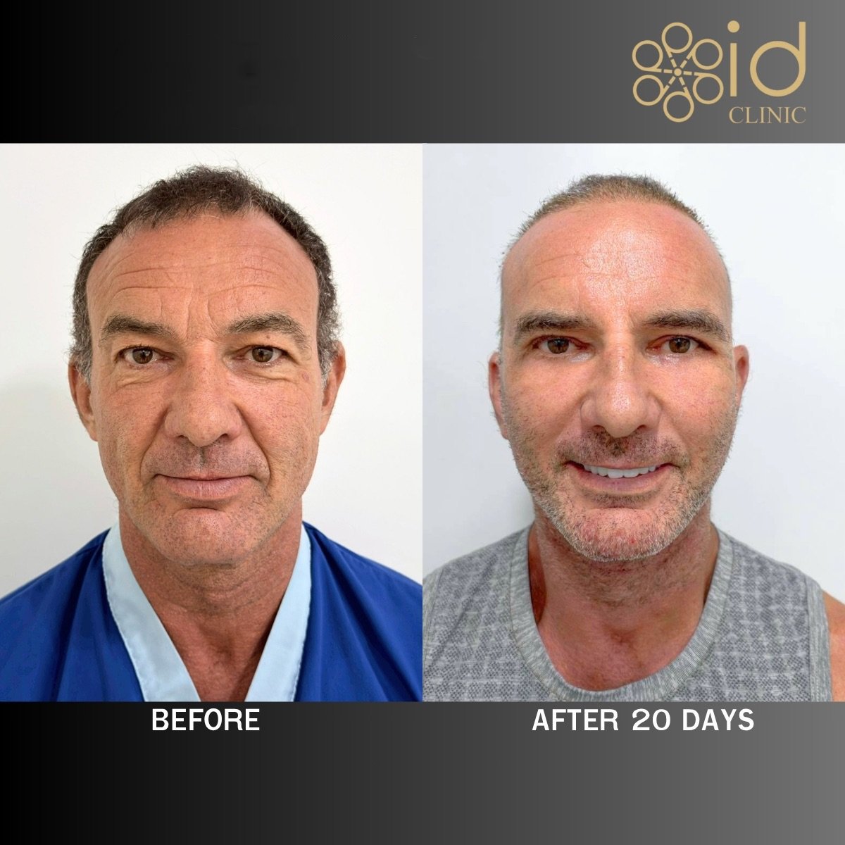 Before and after deep plane facelift results at ID Clinic Bangkok, visible facial rejuvenation