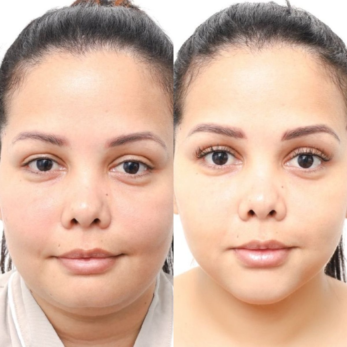 Before and after buccal fat extraction at Wansiri Hospital, slimmer cheeks visible result