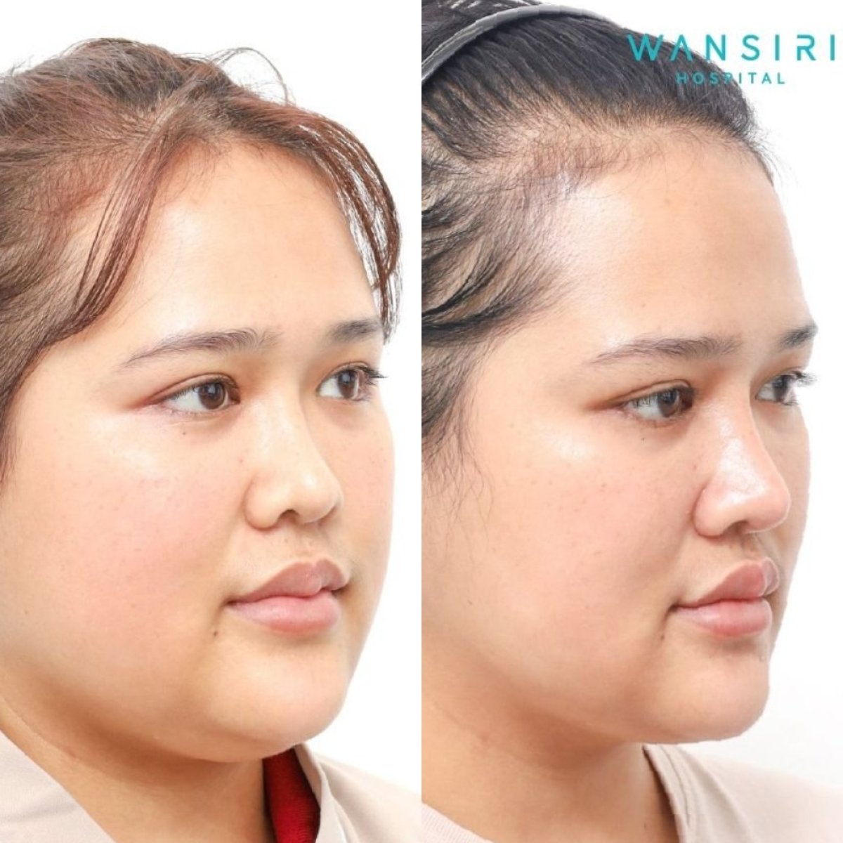 Before and after buccal fat extraction at Wansiri Hospital, slimmer facial contour result