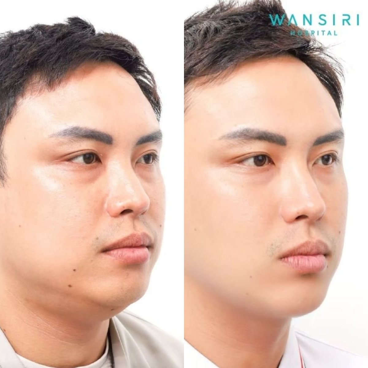 Before and after buccal fat extraction at Wansiri Hospital – slimmer facial contour result