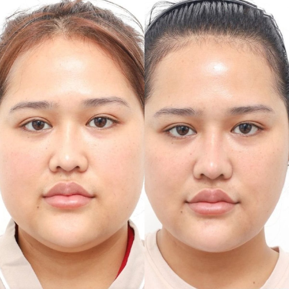 Before and after buccal fat extraction at Wansiri Hospital, slimmer cheeks visible result
