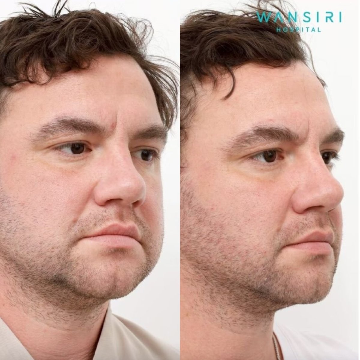 Antes y después de extracción de grasa bucal en Wansiri Hospital, mejillas más delgadas