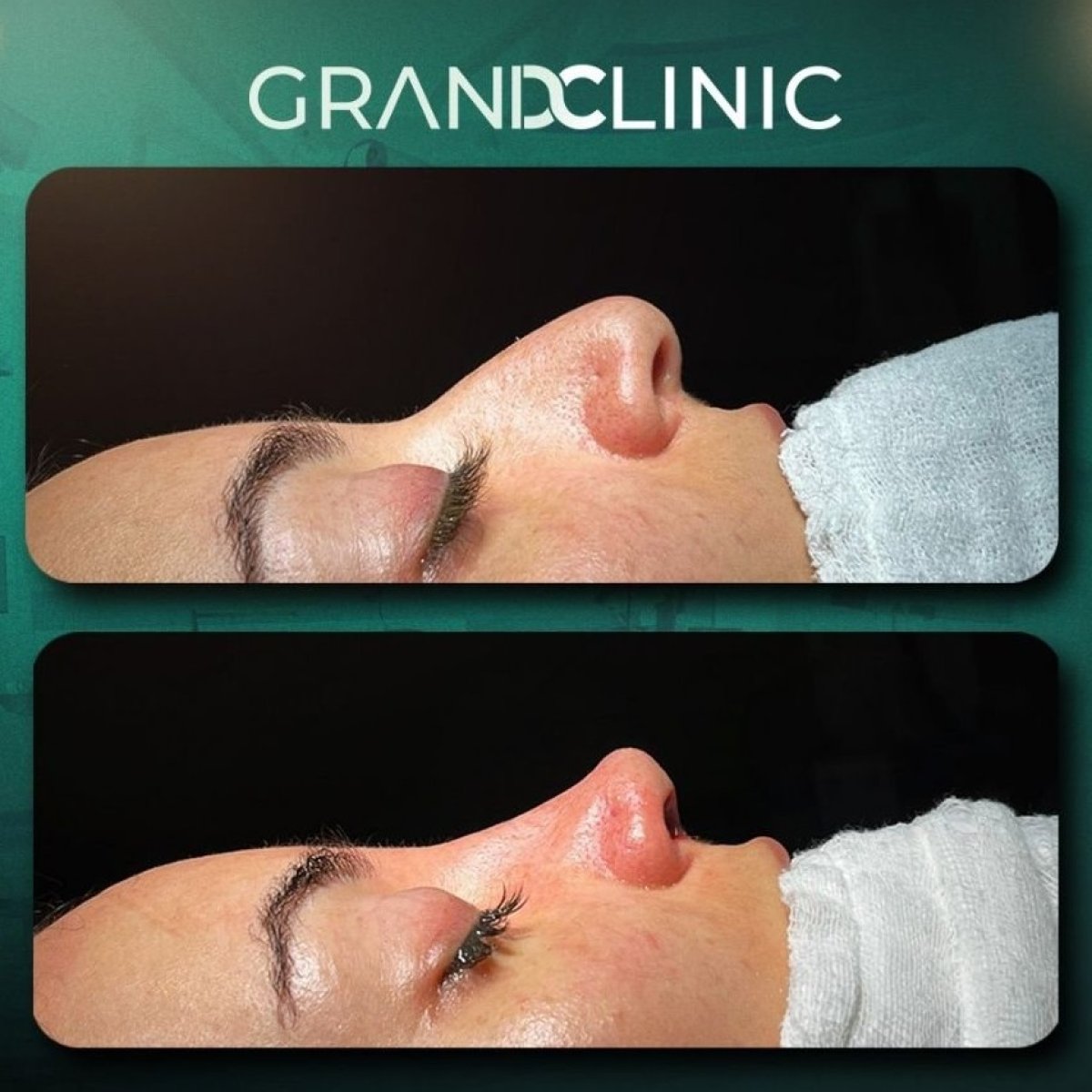 Before and after rhinoplasty result at Grand Clinic, nose reshaping with refined contour