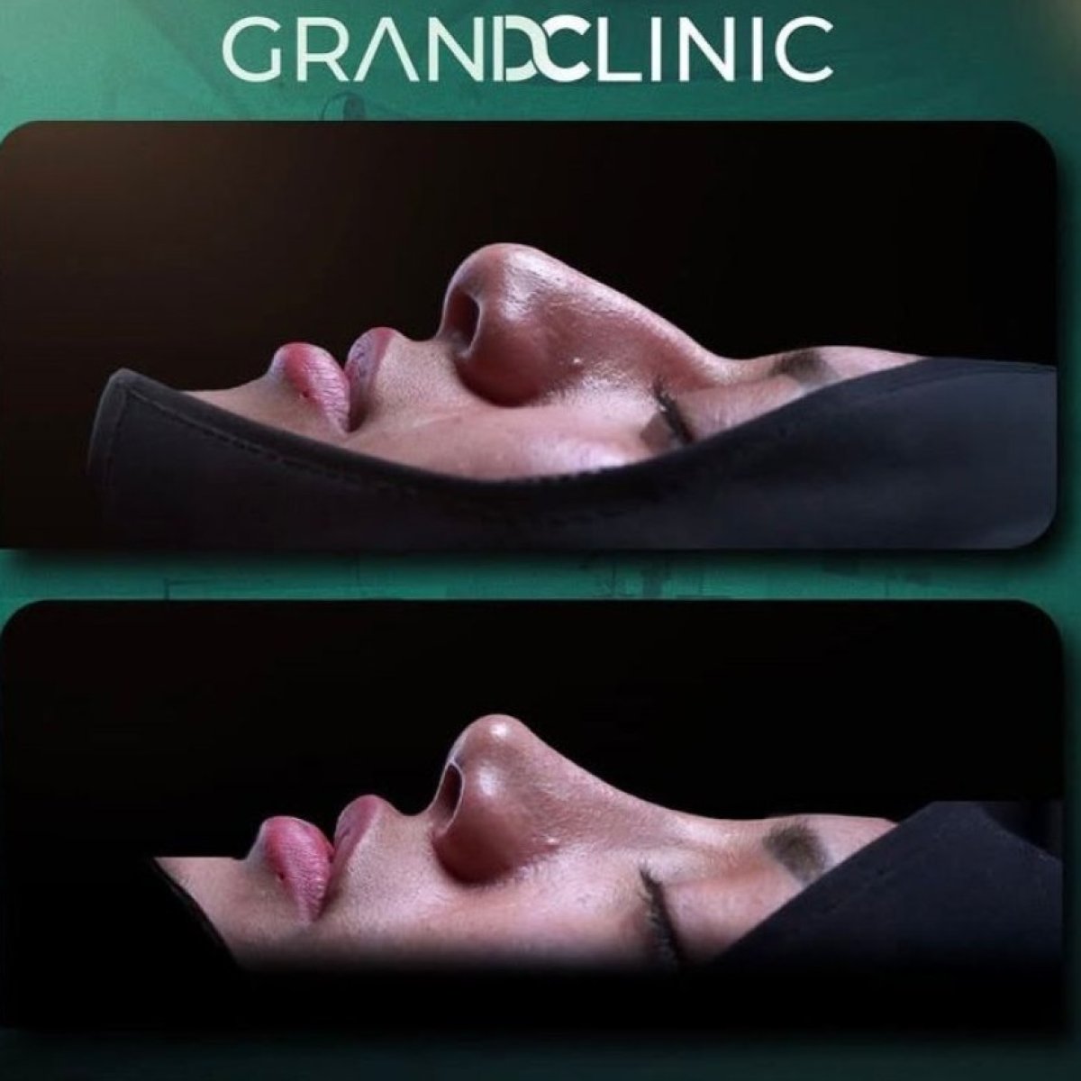 Результаты ринопластики до и после в Grand Clinic, улучшенная форма и профиль носа