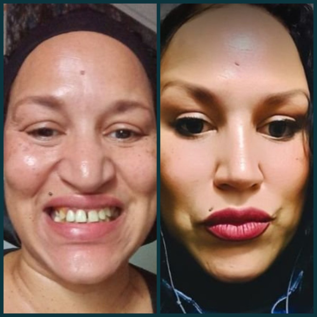 Antes y después de carillas dentales en Grand Clinic, transformación de sonrisa y dientes blancos