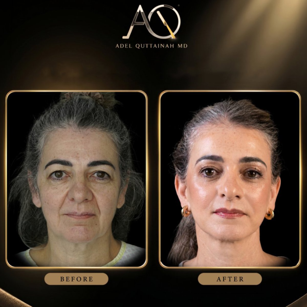 Resultados de lifting facial antes y después en Adel Quttainah MD – rejuvenecimiento facial