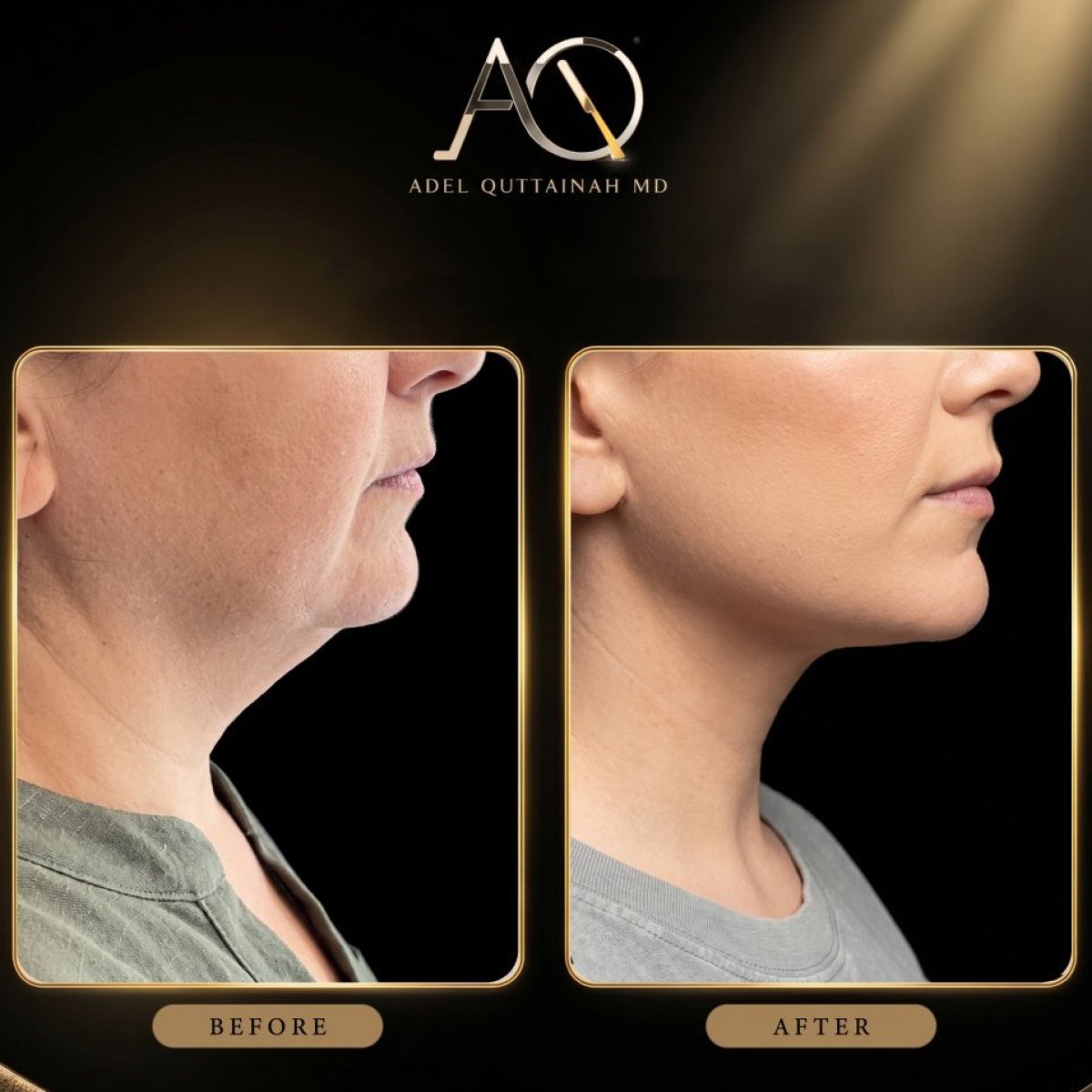 Resultados de lifting de cuello antes y después en Adel Quttainah MD – mandíbula definida
