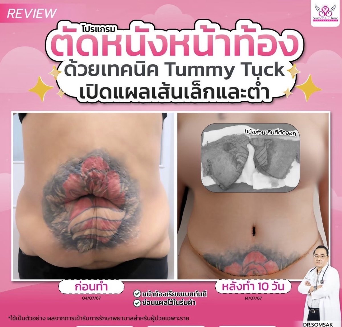 Efekty plastyki brzucha w Somchai Clinic – płaski brzuch po 10 dniach
