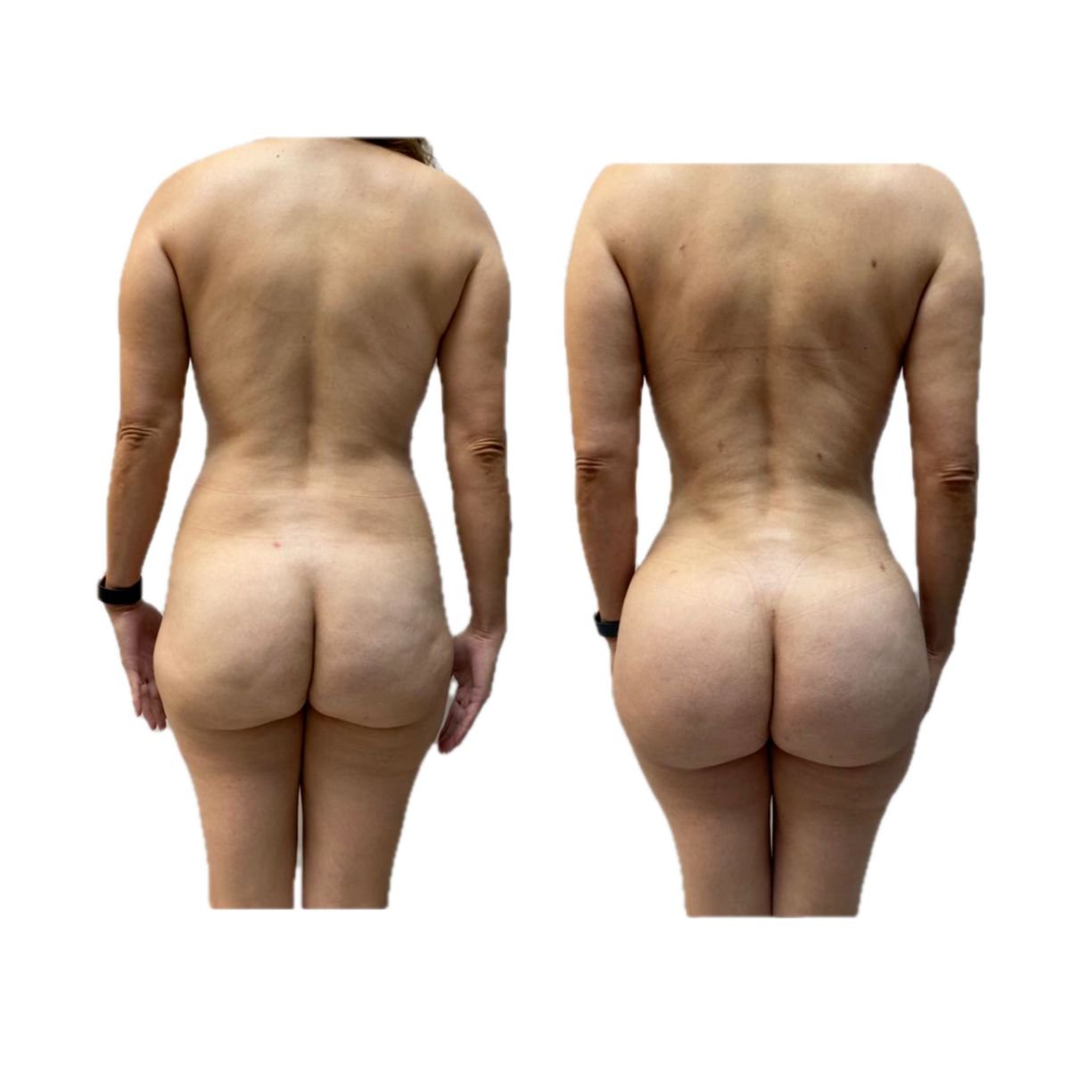 Mommy makeover before and after results at Hospital de la Familia, improved body contour