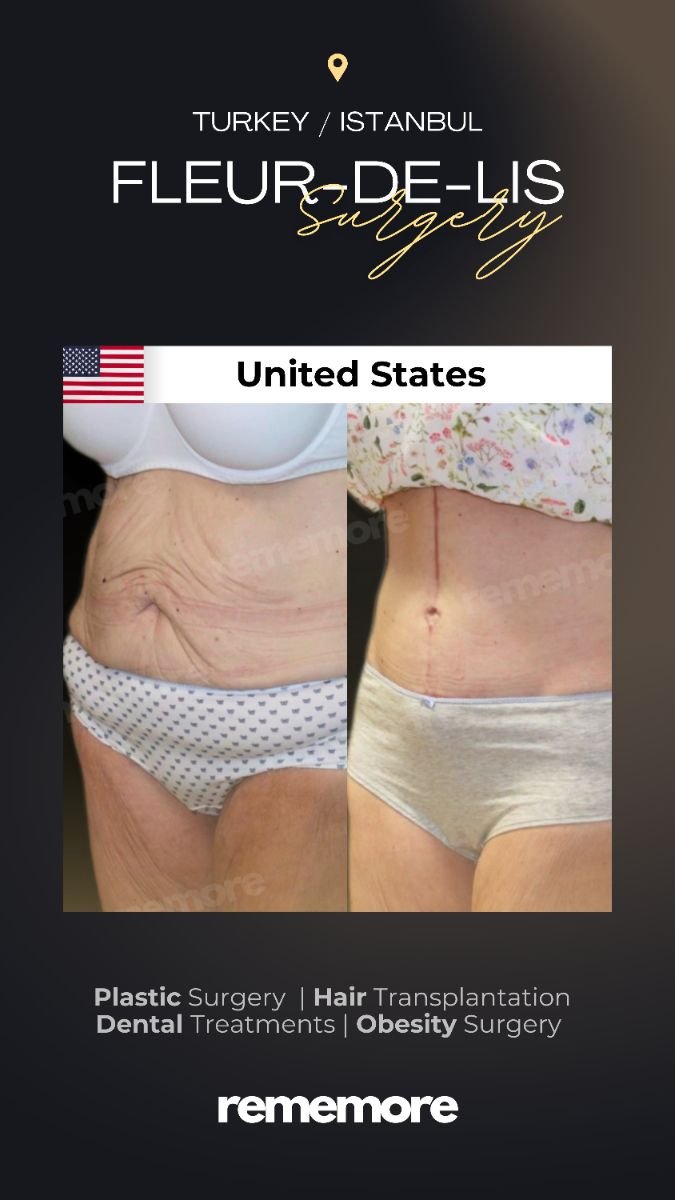Resultados antes y después de lifting corporal Fleur-de-Lis en Memorial Göztepe Hospital, abdomen