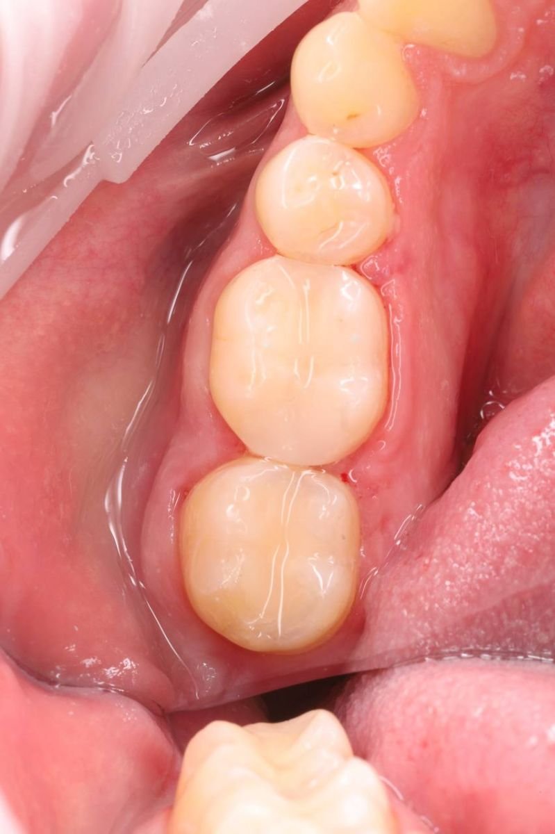 Результат видалення зуба в Dental Clinic Dynasty Stomatology у Кракові, загоєна ясна