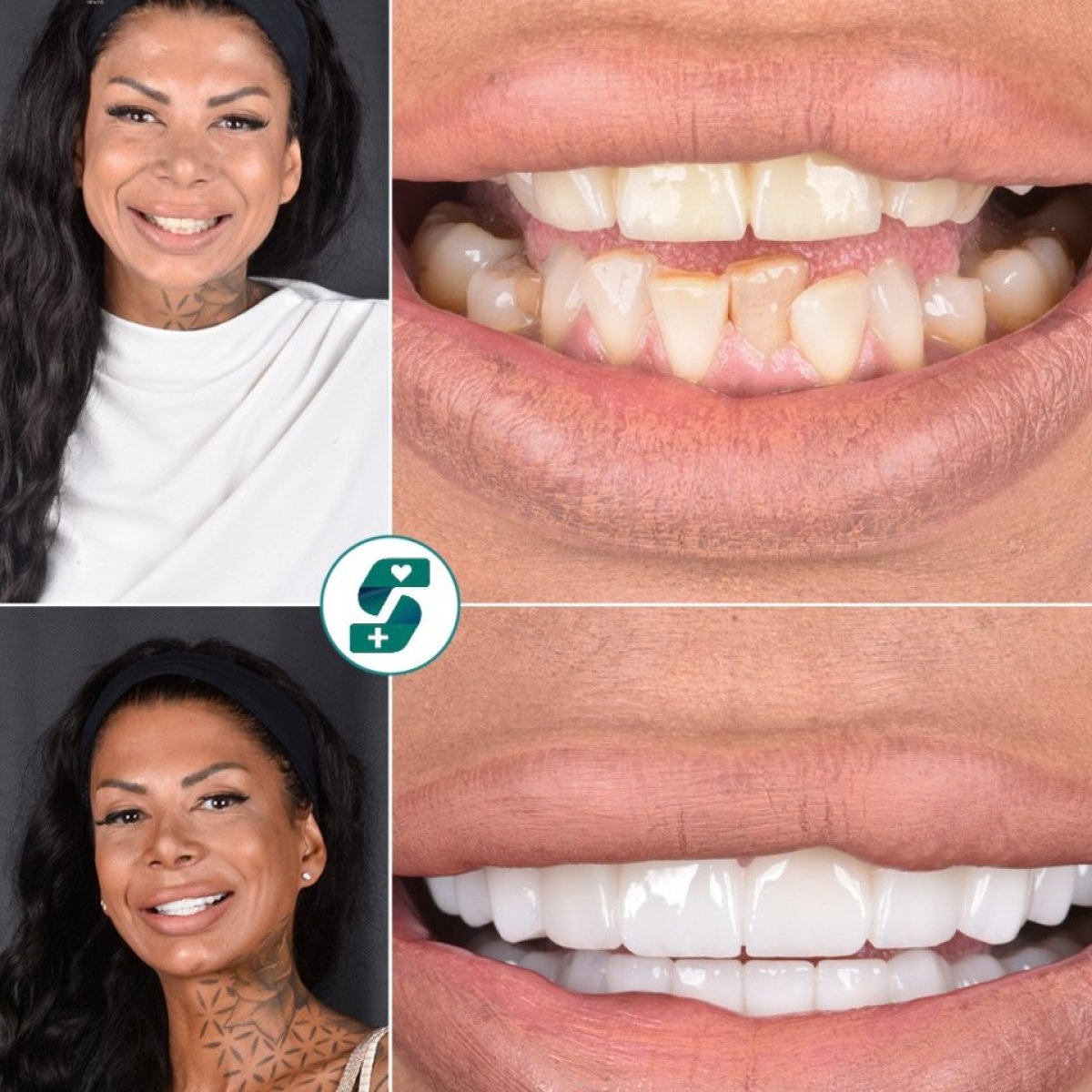 Before and after zirconia crown results at Soraca Med – improved smile and whiter teeth