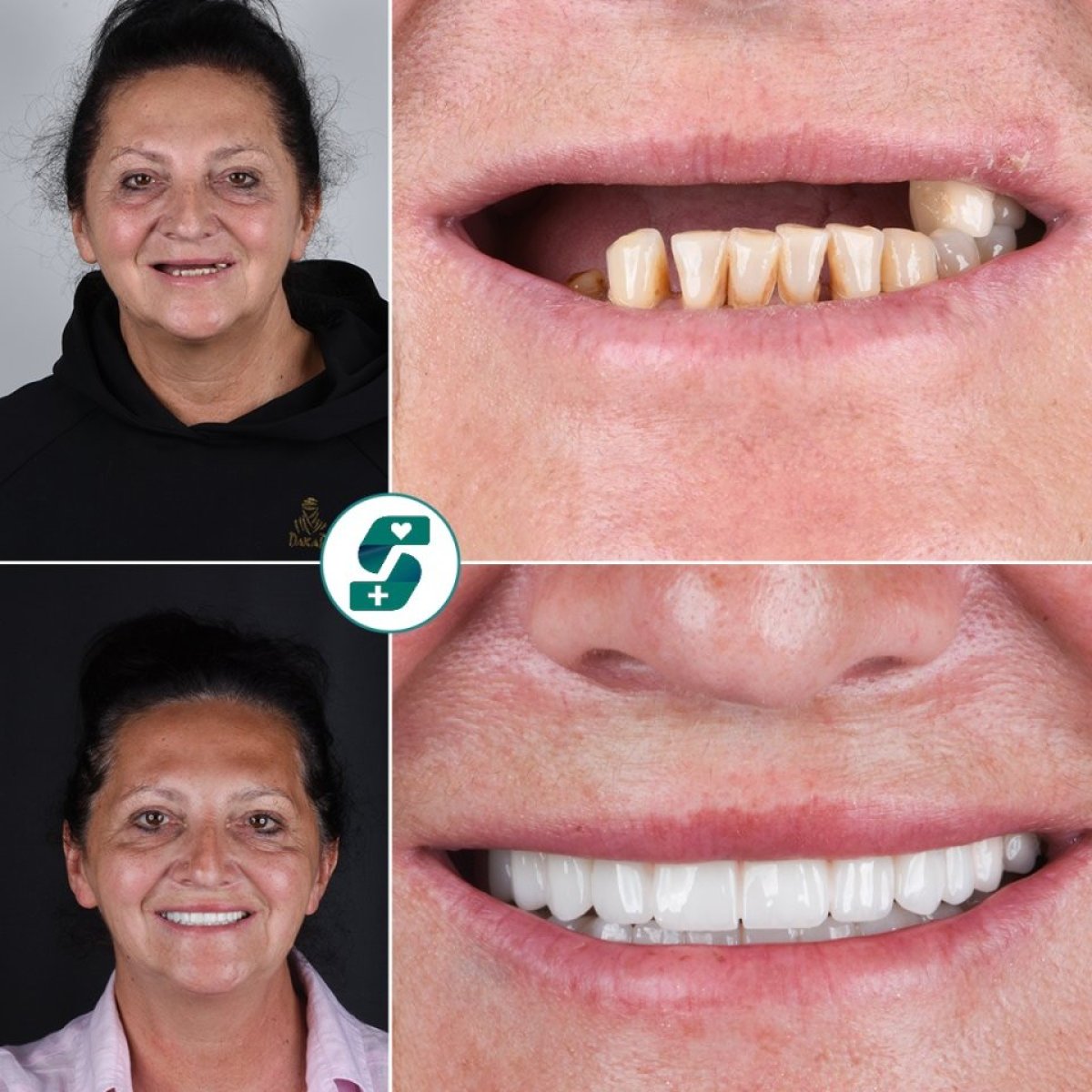 Before and after dental implant results at Soraca Med – restored smile and improved teeth