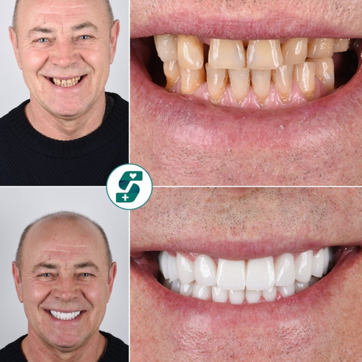 Before and after zirconia crown installation at Soraca Med – visible smile transformation result