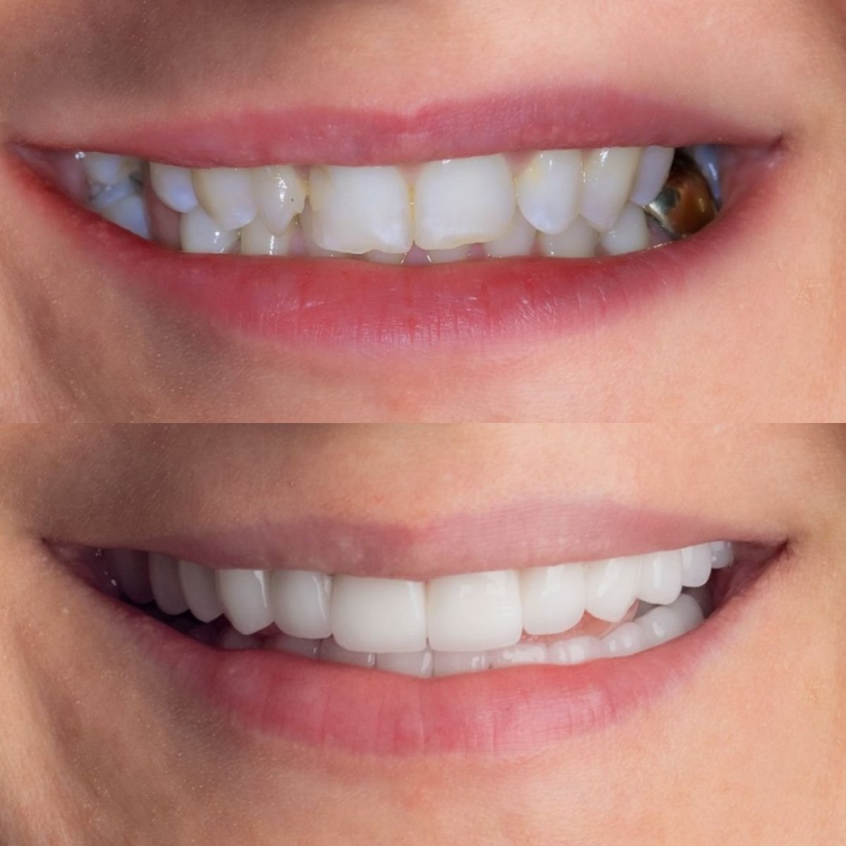 Результат до и после установки виниров Emax в Tower Dental Clinic – естественная улыбка