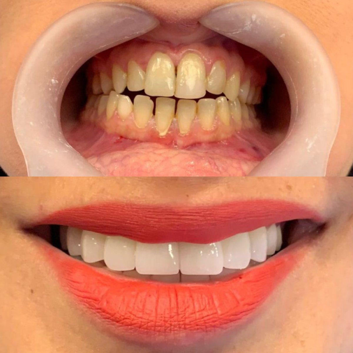 До и после установки виниров Emax в Tower Dental Clinic – результат преображения улыбки