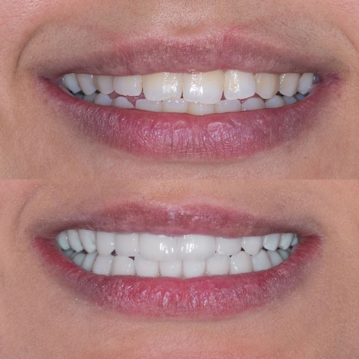 Antes y después de carillas Emax en Tower Dental Clinic, transformación natural de la sonrisa