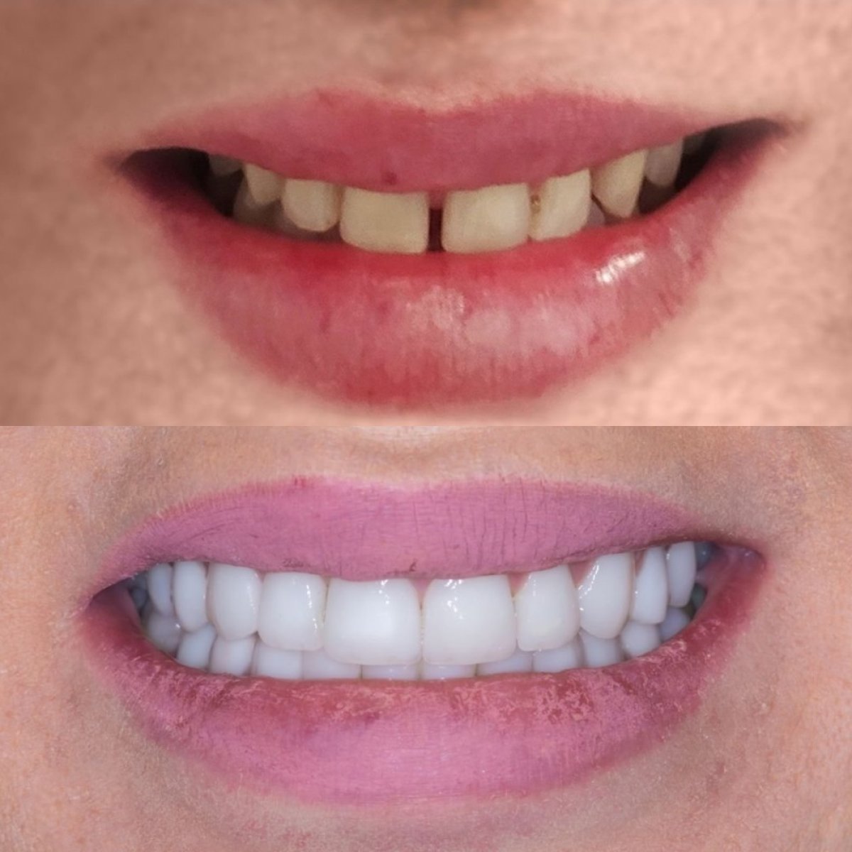 Результат до та після встановлення Emax-вінірів у Tower Dental Clinic – покращення усмішки