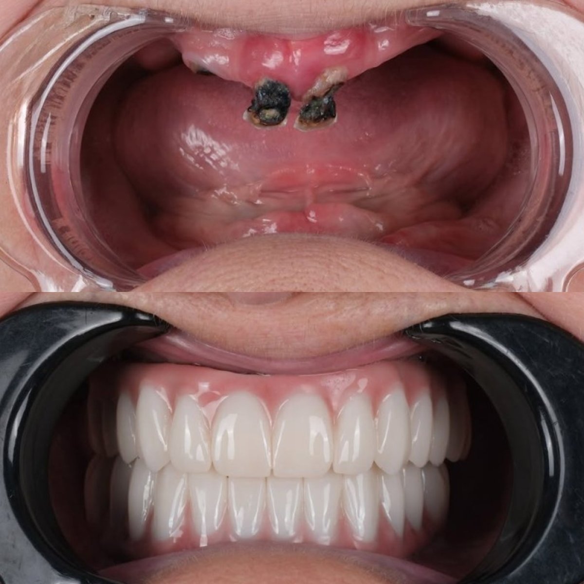 نتيجة قبل وبعد زراعة الأسنان All-on-6 في يوم واحد في عيادة Antalya Smile Designs