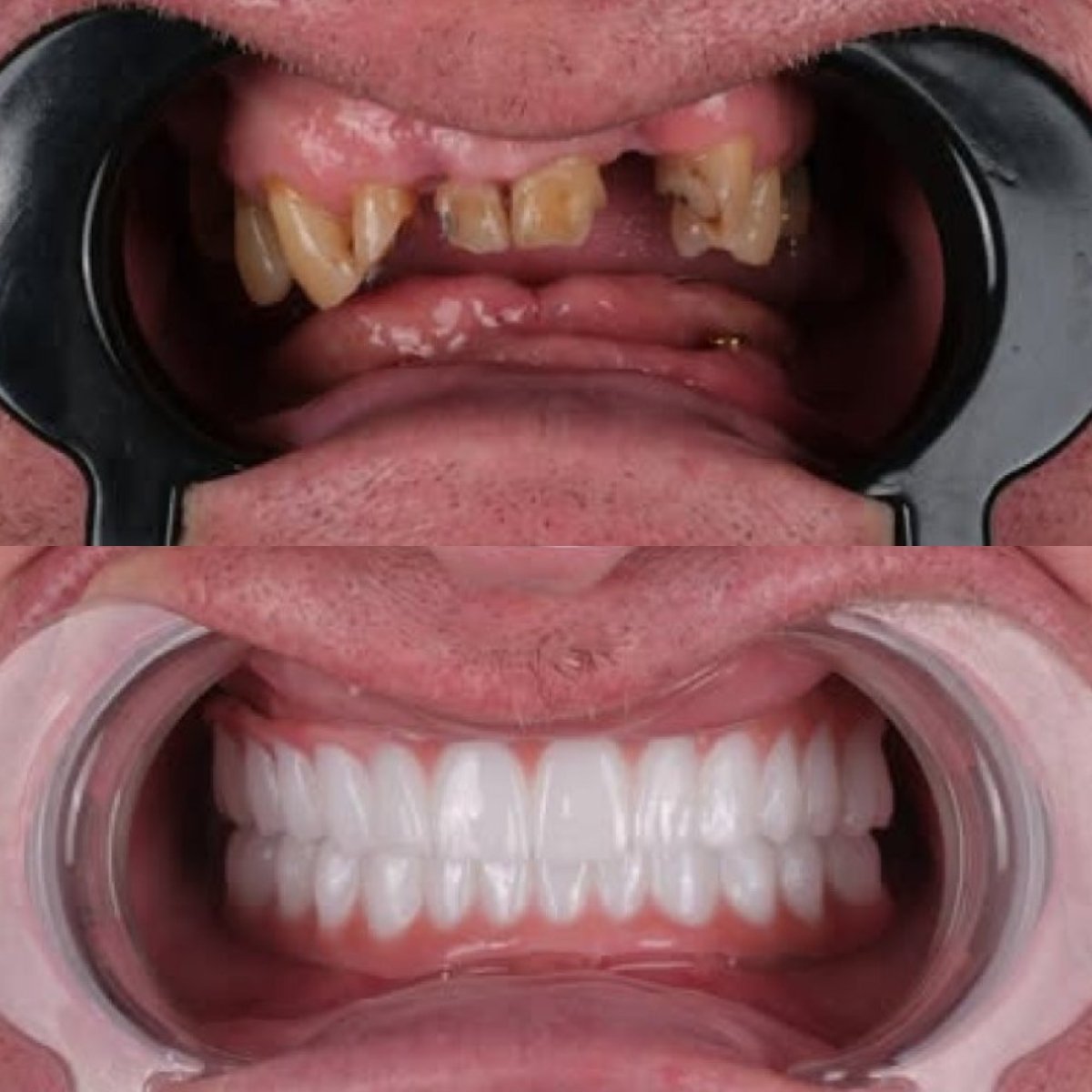 نتائج قبل وبعد تيجان معدنية خزفية في Antalya Smile Designs – استعادة الابتسامة الكاملة