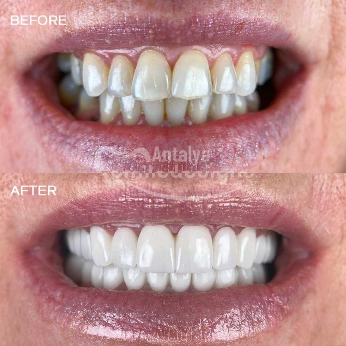 Before and after tooth whitening results at Antalya Smile Designs – visibly brighter smile