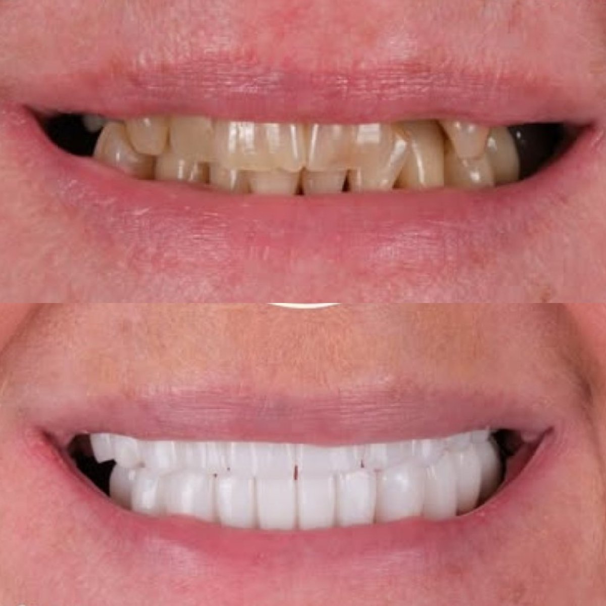 Smile makeover before and after results at Antalya Smile Designs – whiter, even teeth transformation