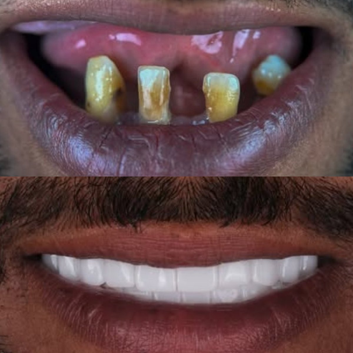 Smile makeover before and after results at Antalya Smile Designs with dental veneers