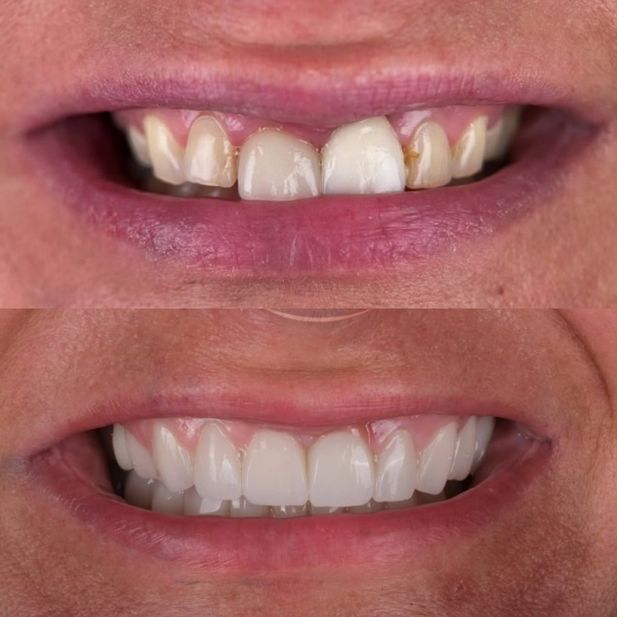 Before and after Hollywood Smile results with dental veneers at Antalya Smile Designs clinic