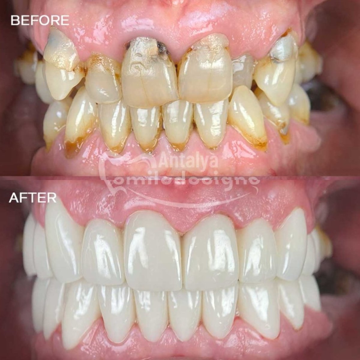 Efekty przed i po bondingowaniu zębów w Antalya Smile Designs – poprawa uśmiechu