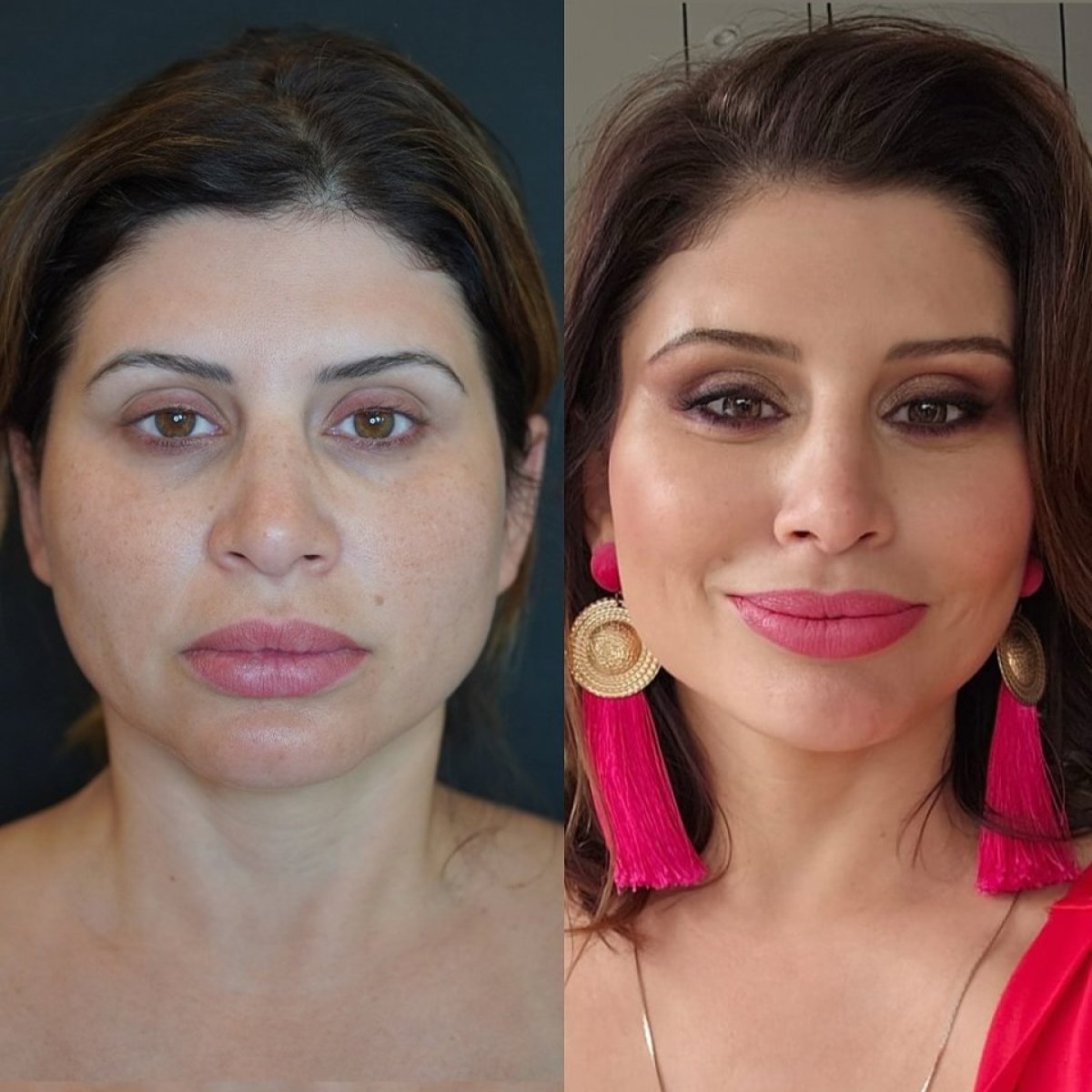 نتائج رفع الحاجب قبل وبعد في Ali Cetinkaya M.D.، مظهر عيون أكثر شبابًا