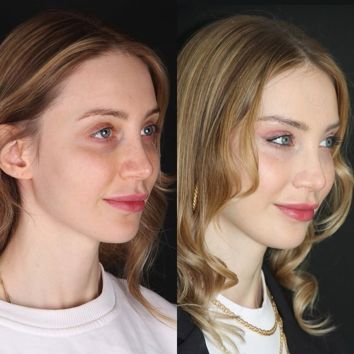 Before and after brow lift results at Ali Cetinkaya M.D., enhanced eyebrow and eye area