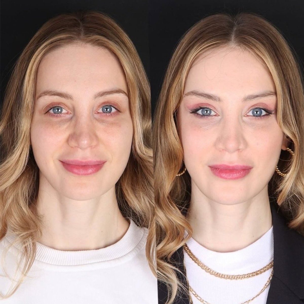 Before and after brow lift results at Ali Cetinkaya M.D., enhanced youthful eye appearance