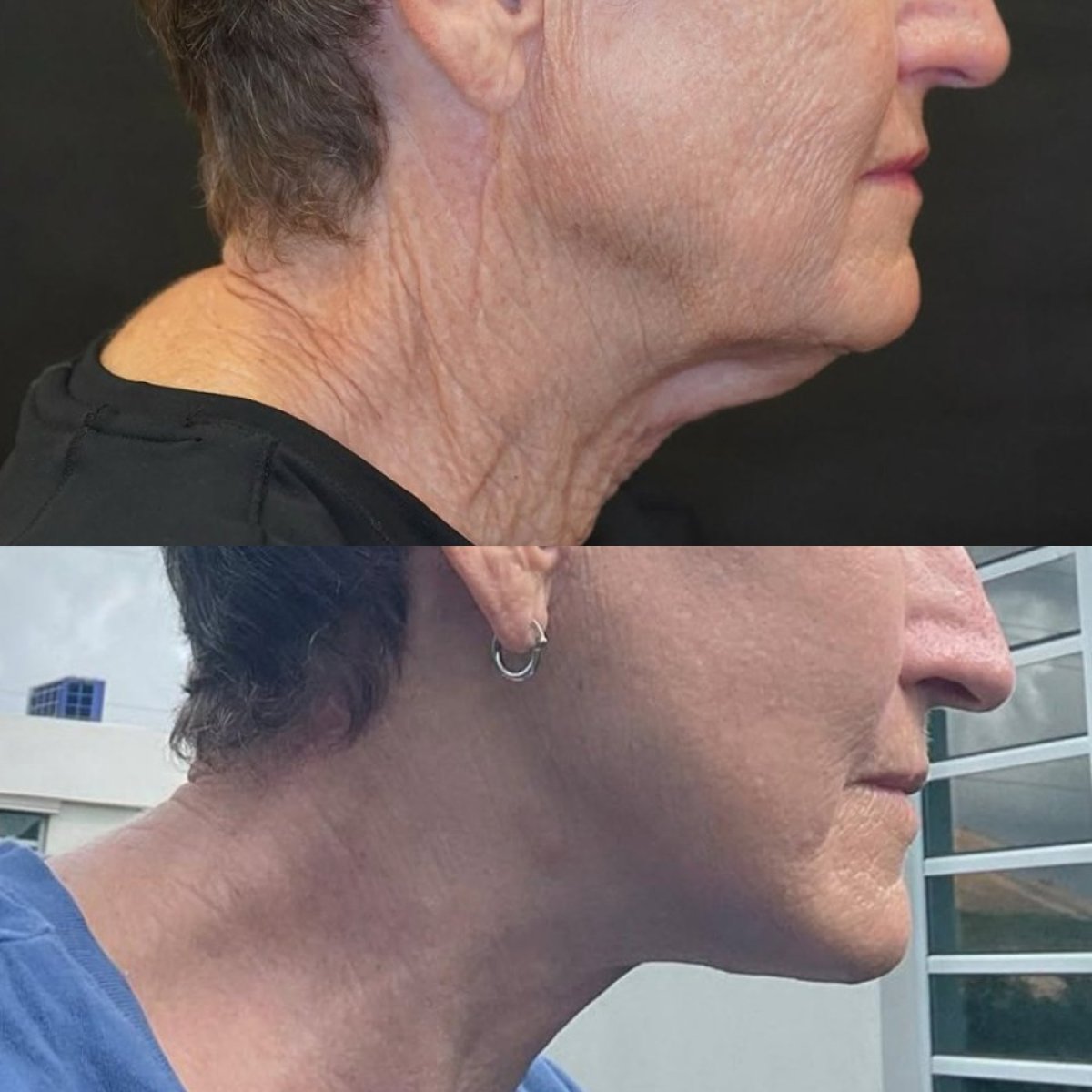 Before and after deep plane facelift results at Ali Cetinkaya M.D., visible neck tightening