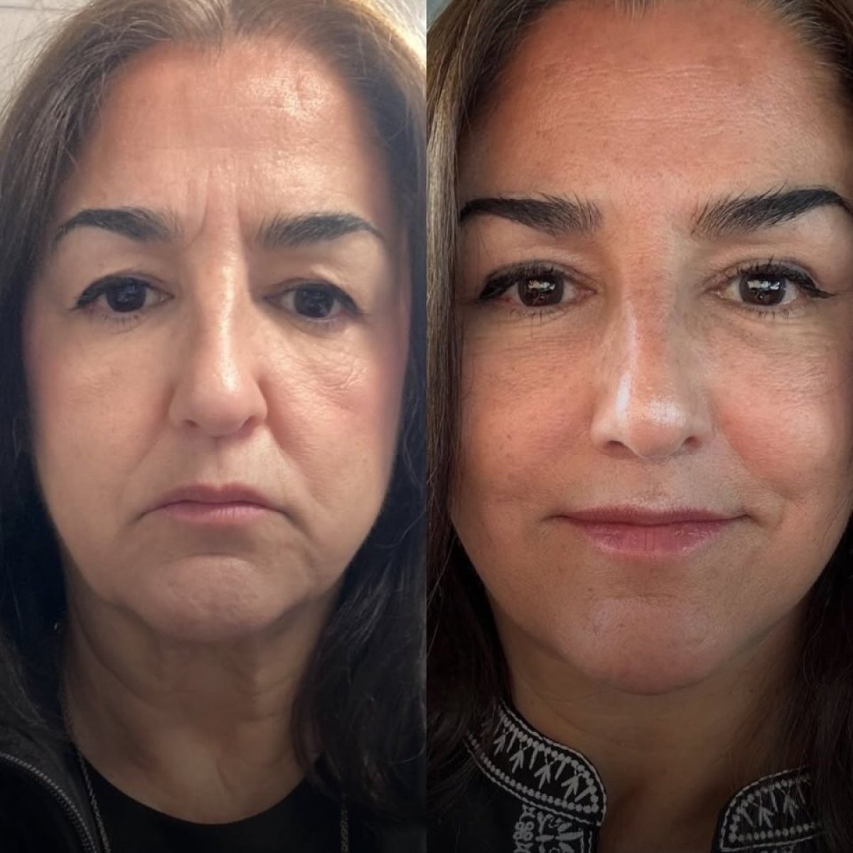 Before and after Deep Plane Facelift results at Ali Cetinkaya M.D., facial rejuvenation visible