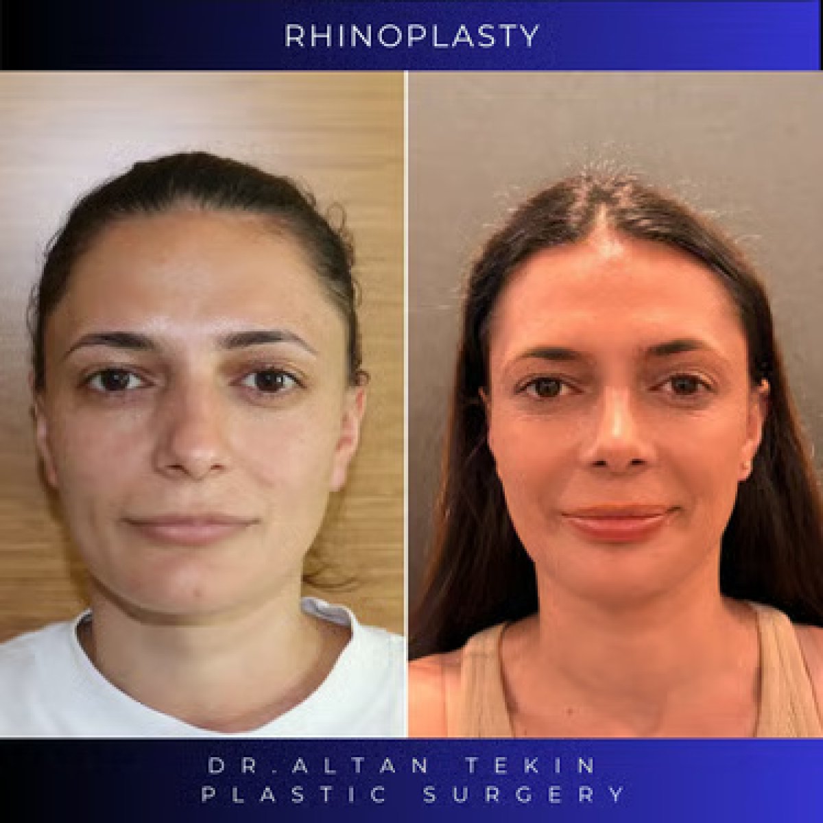 Before and after rhinoplasty results at Altan Tekin Clinic, nose reshaping for natural look
