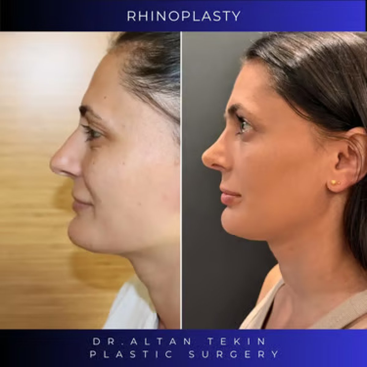 Before and after rhinoplasty results at Altan Tekin Clinic, improved nose shape profile