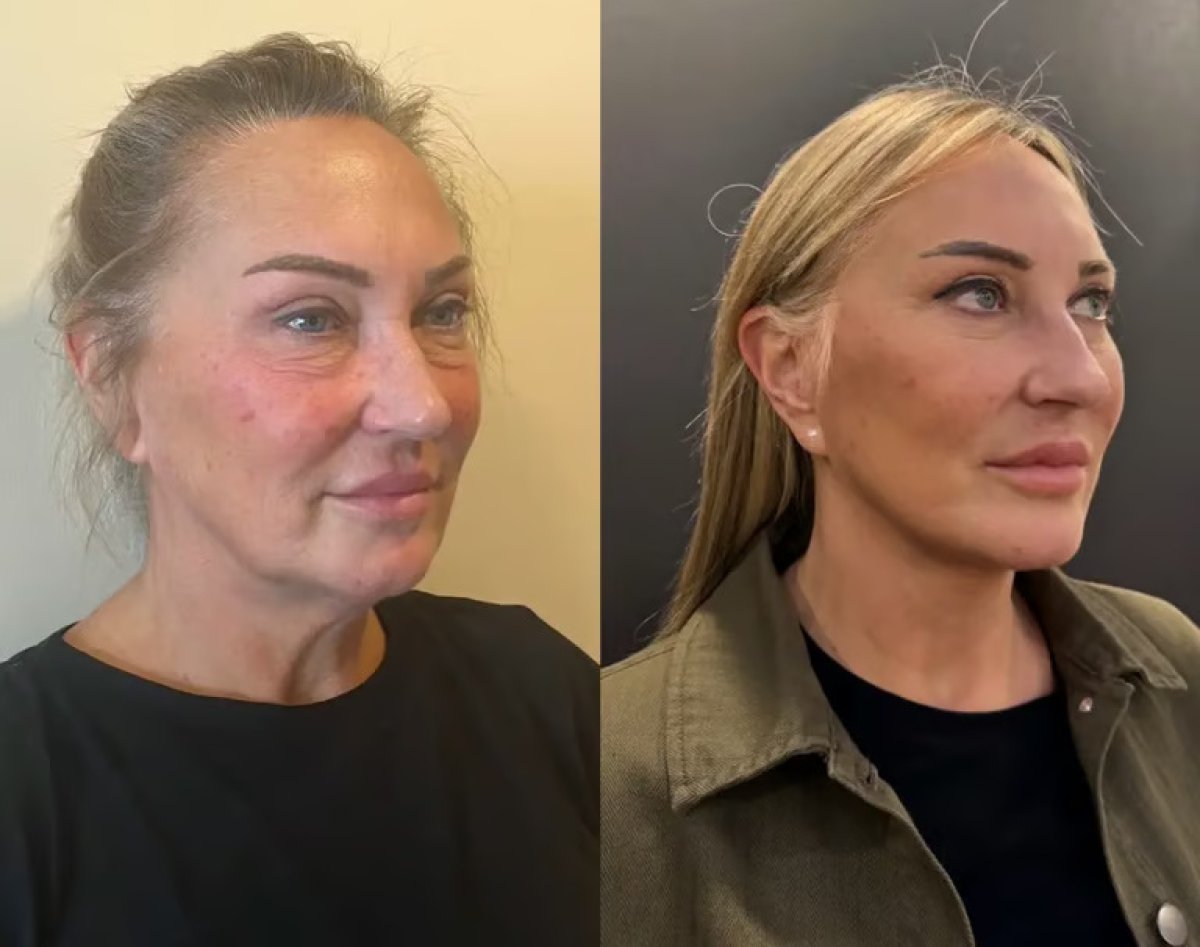 Facelift before and after results at Altan Tekin Clinic, visible facial rejuvenation effect