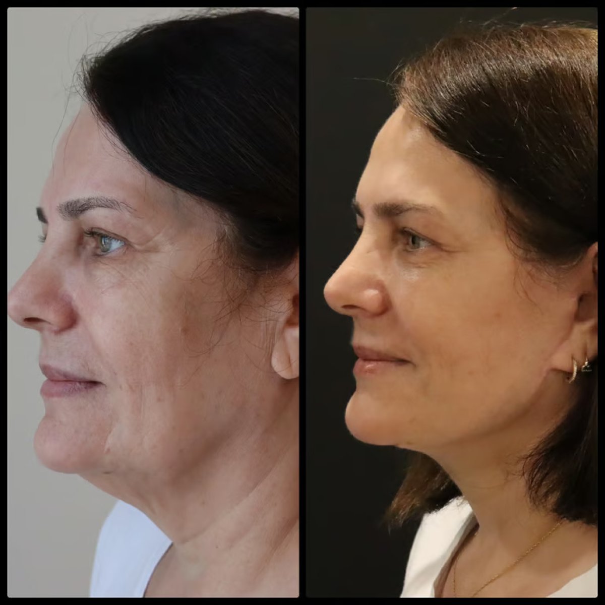 Facelift before and after results at Altan Tekin Clinic, visible facial rejuvenation effect