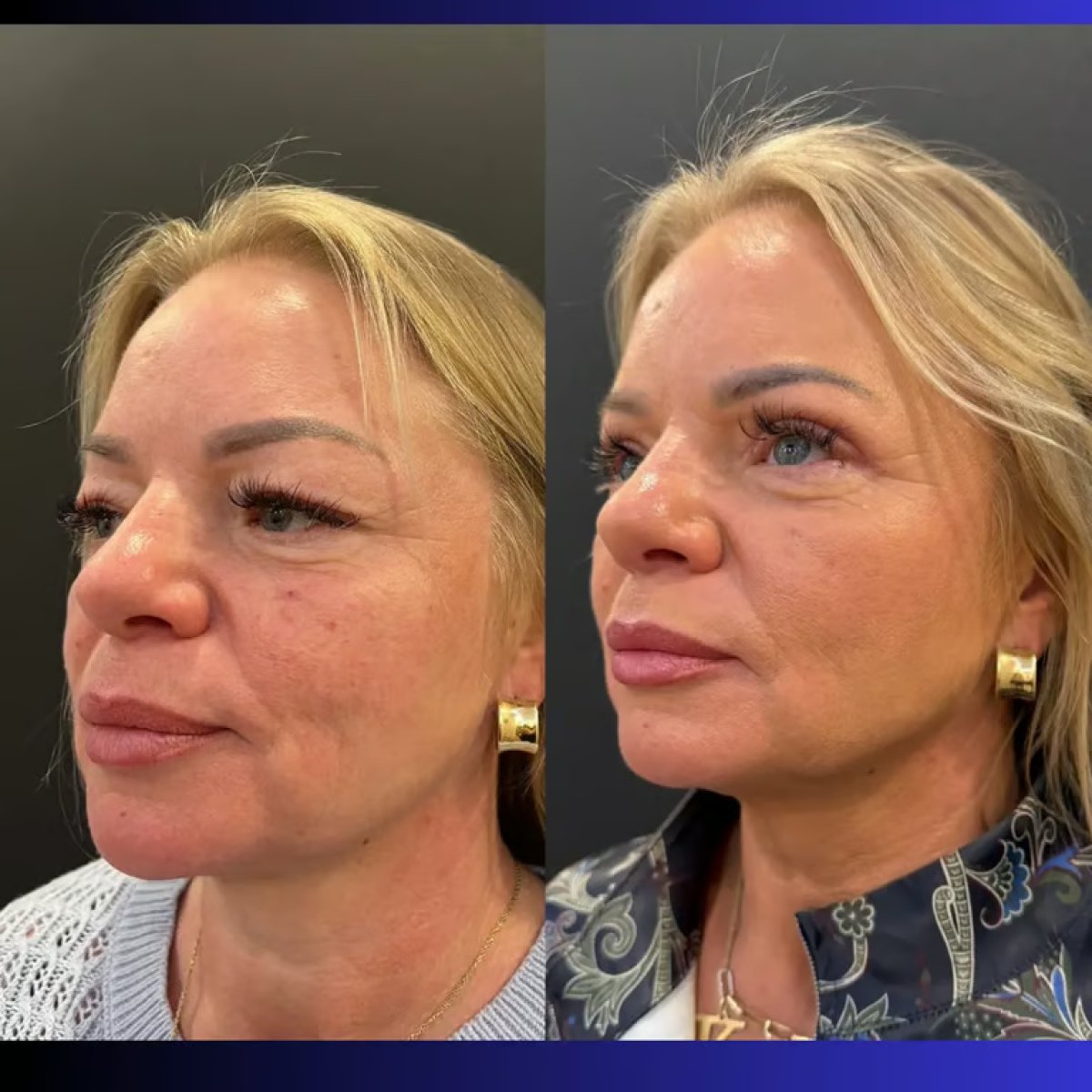 Facelift before and after results at Altan Tekin Clinic, visible facial rejuvenation effect