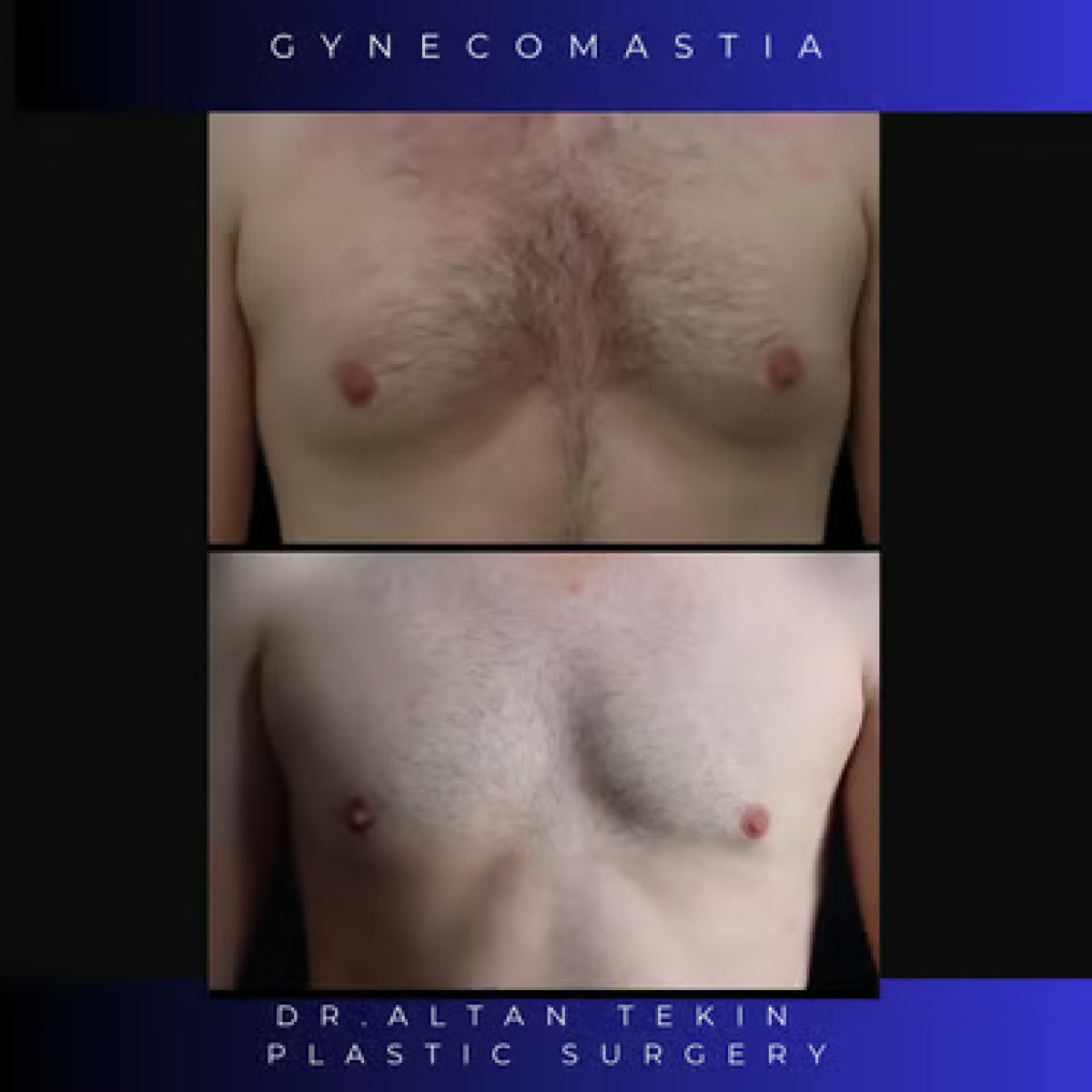 Before and after gynecomastia surgery results at Altan Tekin Clinic, male chest contouring