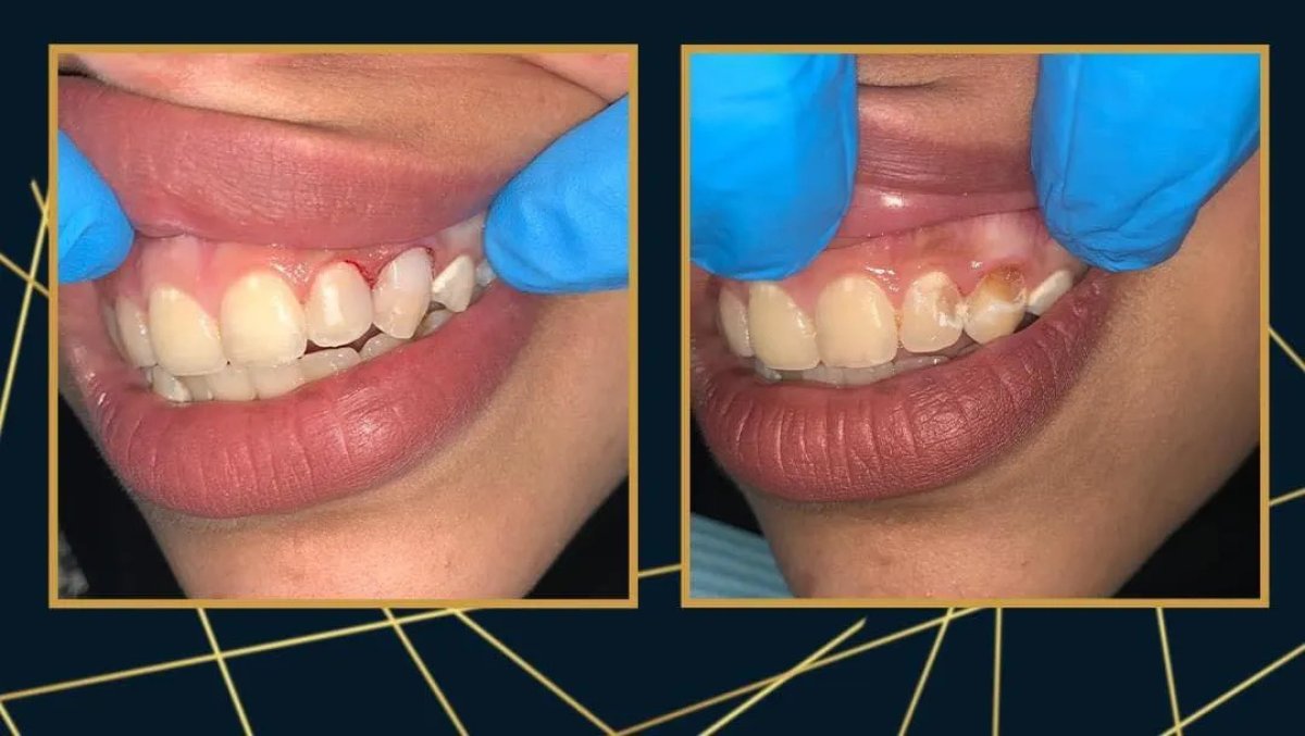 Resultados de antes y después de bonding dental en ElGamal Clinic, mejor forma y color dental