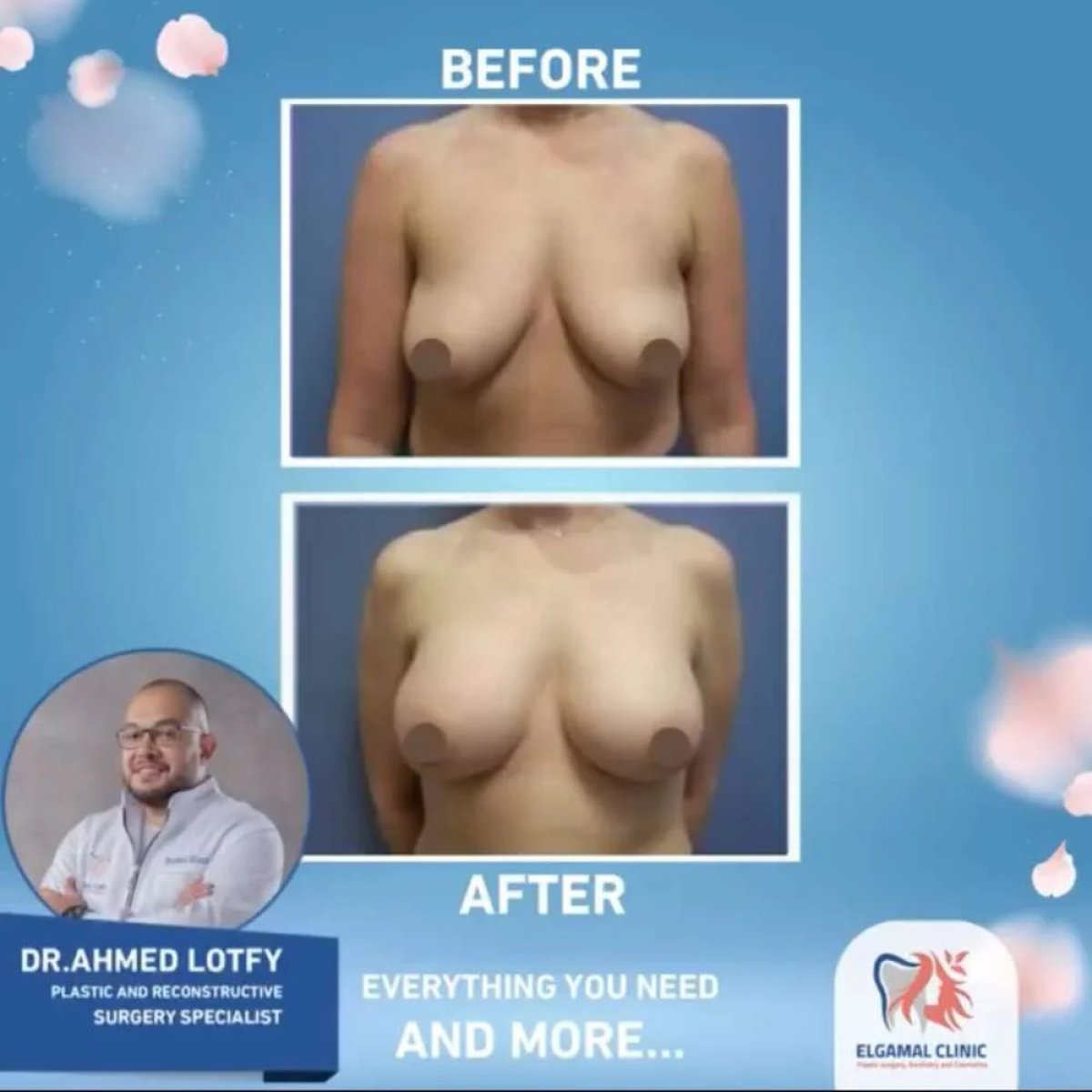 Before and after breast augmentation results at ElGamal Clinic, improved breast shape