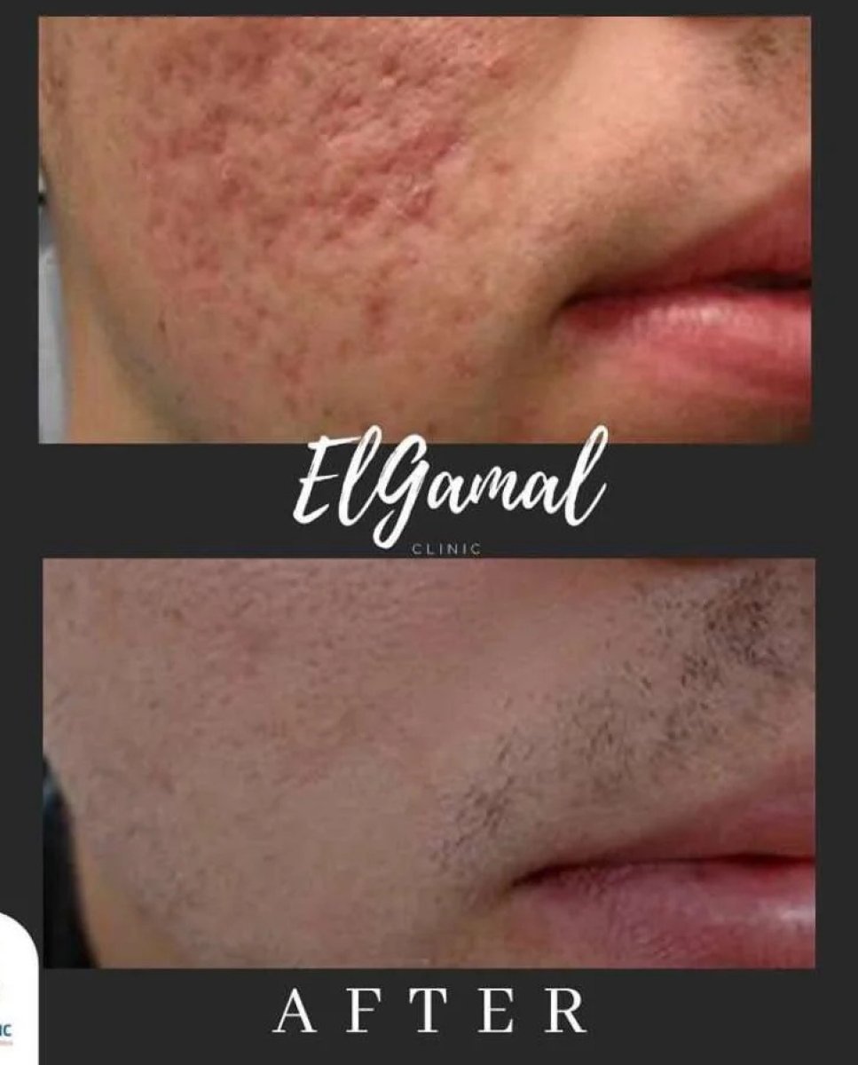 Before and after laser scar removal at ElGamal Clinic, improved facial skin texture result