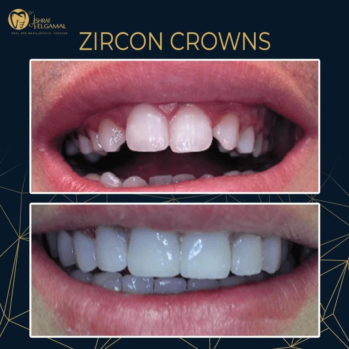 Before and after zirconia dental crowns at ElGamal Clinic – smile restoration results